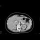 Edematous pancreatitis: CT - Computed tomography